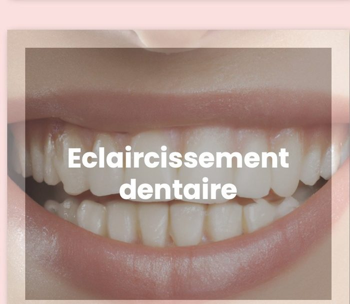 Éclaircissement dentaire